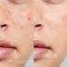 Антибактериальный штрих для проблемной кожи лица Anti-Bac Touch Acnevect ELDAN 10 мл
