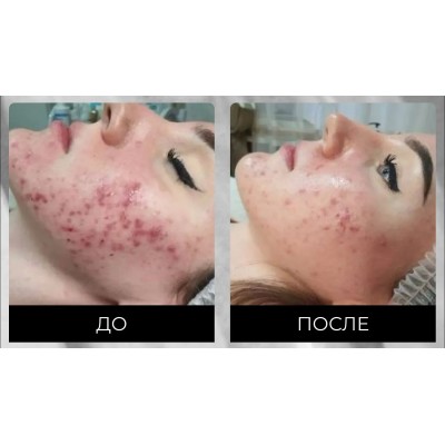 Сыворотка Evasion Dermafile ADN Anti Acne 4 мл