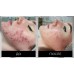 Сыворотка Evasion Dermafile ADN Anti Acne 4 мл